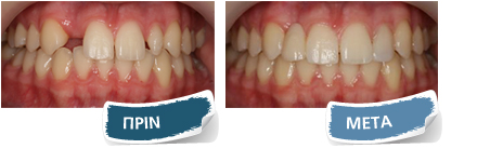 Εμφυτεύματα - Πριν - Μετά