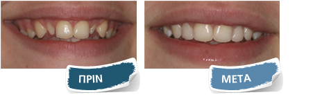 Εμφυτεύματα - Πριν - Μετά