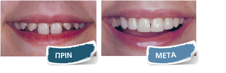 Εμφυτεύματα - Πριν - Μετά