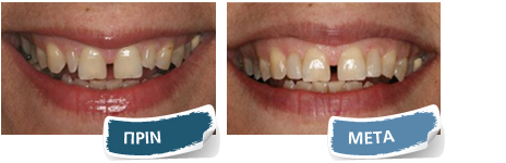 Εμφυτεύματα - Πριν - Μετά