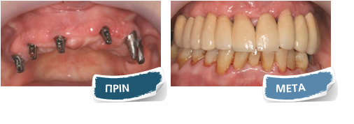 Εμφυτεύματα - Πριν - Μετά