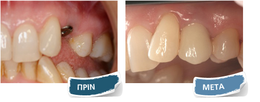 Εμφυτεύματα - Πριν - Μετά