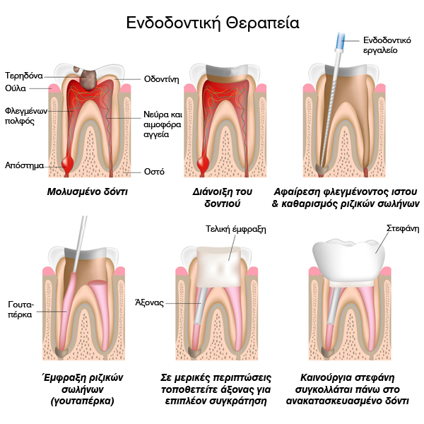 Ενδοδοντική Θεραπεία