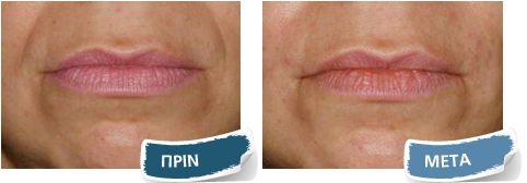 Υαλουρονικο Οξύ