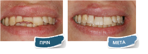 Όψεις σύνθετης ρητίνης