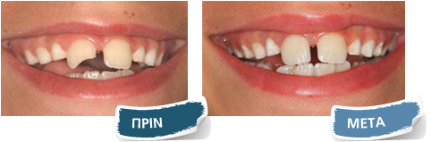 Όψεις σύνθετης ρητίνης