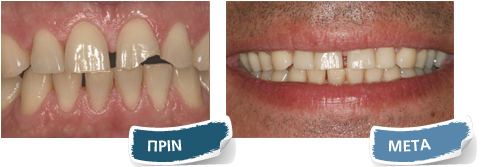 Όψεις σύνθετης ρητίνης