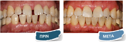 Όψεις σύνθετης ρητίνης