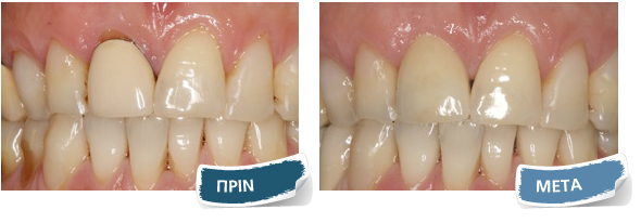 Όψεις σύνθετης ρητίνης