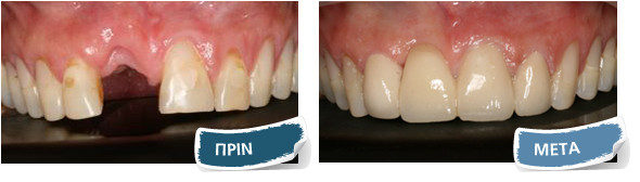 Όψεις σύνθετης ρητίνης
