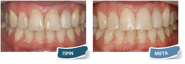 Όψεις σύνθετης ρητίνης