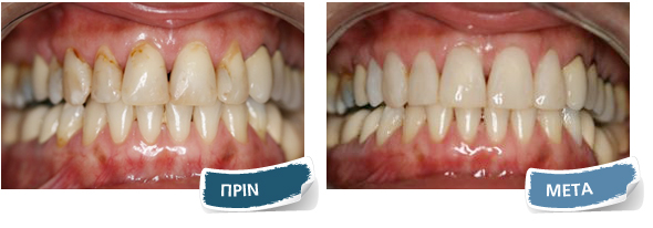 Όψεις σύνθετης ρητίνης