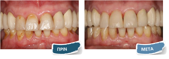 Όψεις σύνθετης ρητίνης