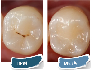Sealant - Πριν - Μετά